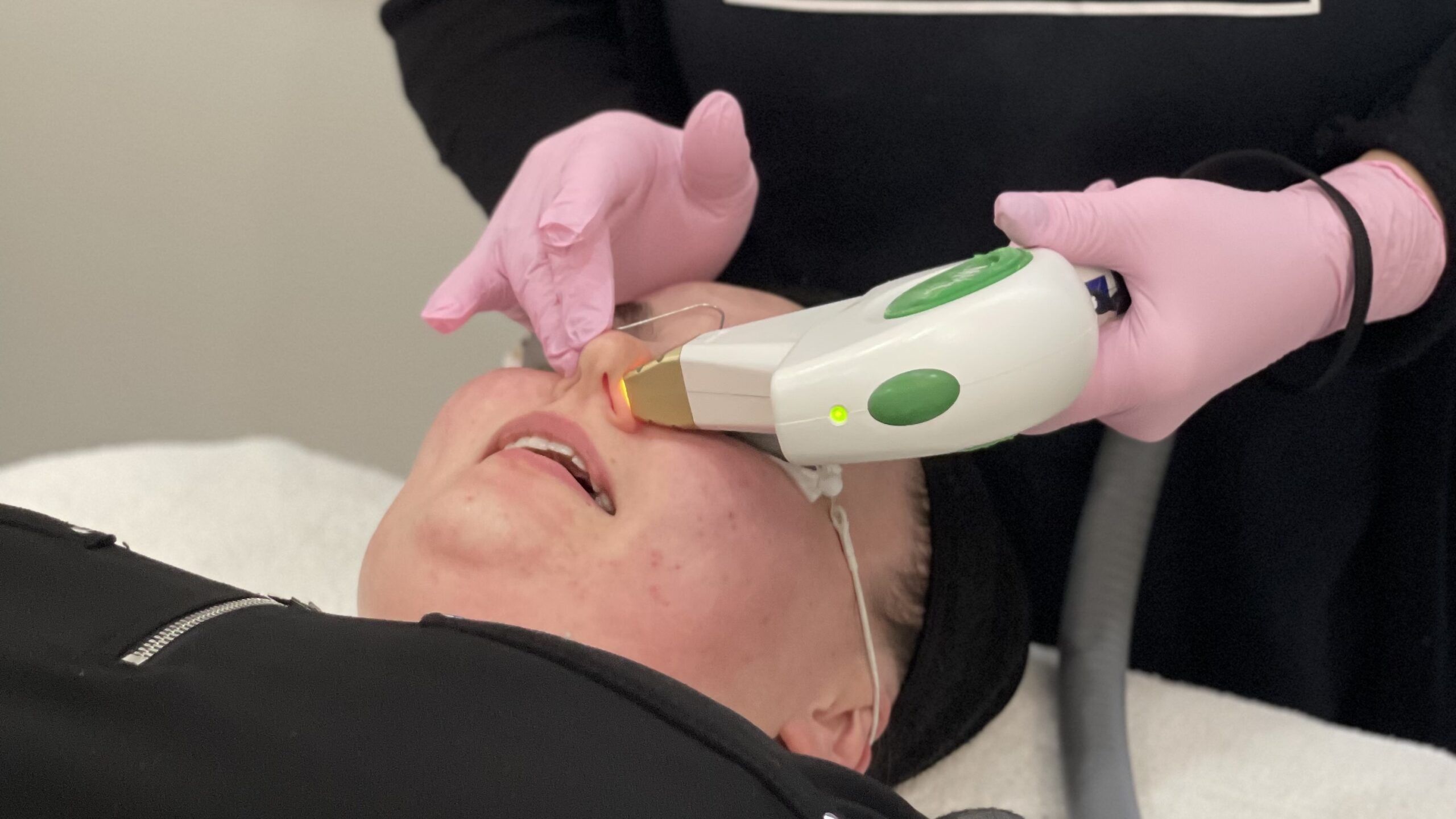 photofacial treatment on model