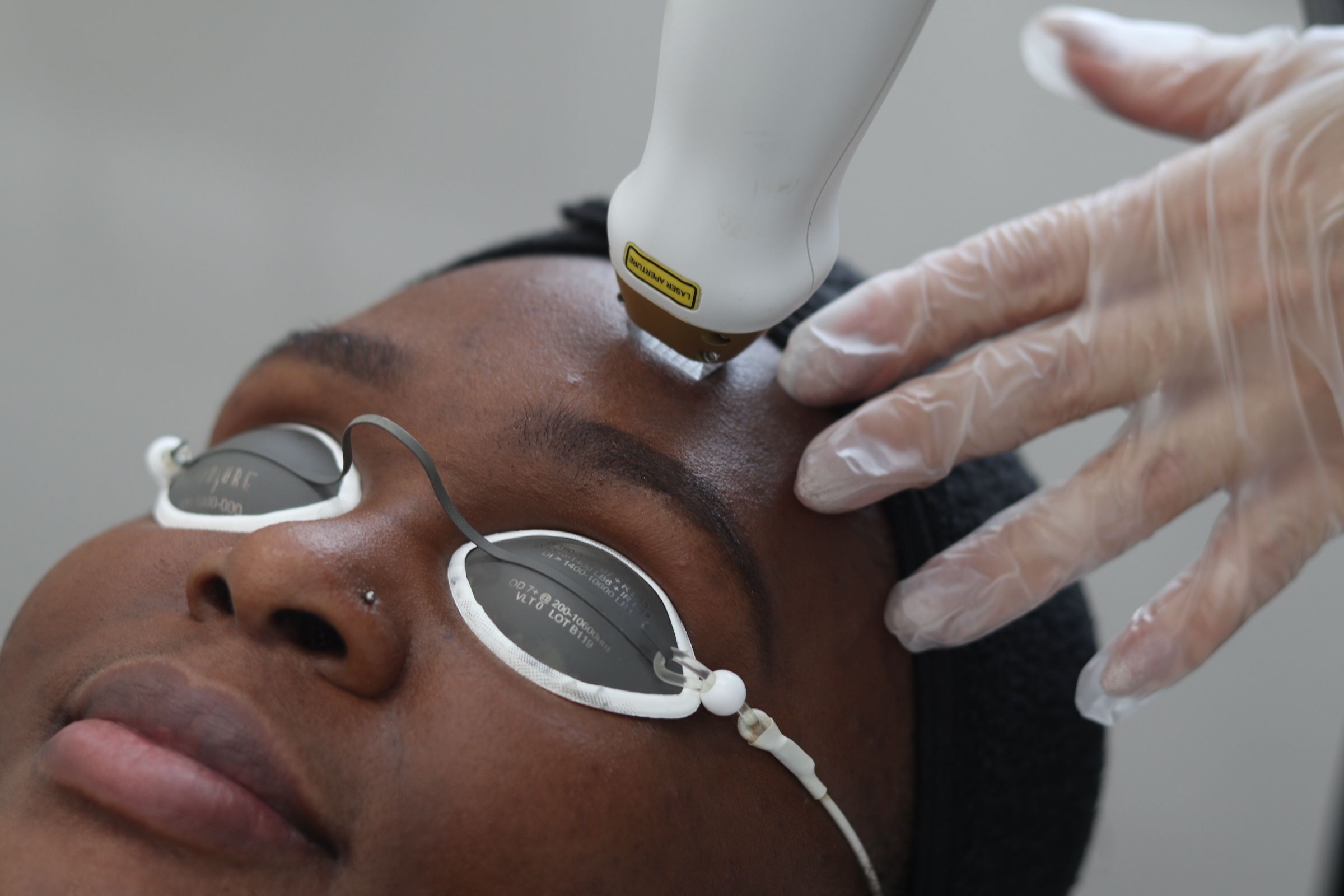 Model getting a fractional laser treatment on forehead