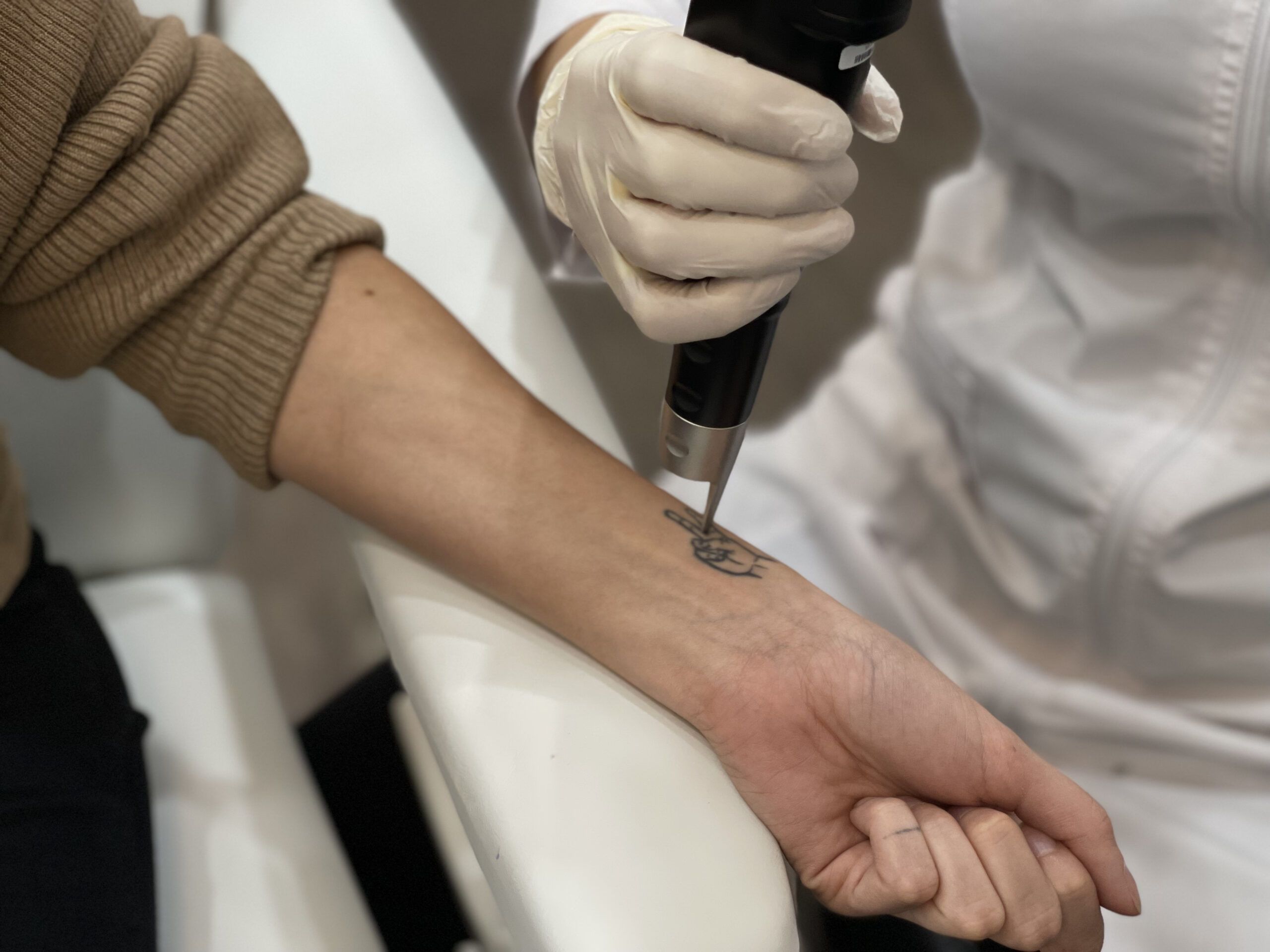 Using a laser tattoo removal machine on a client's arm