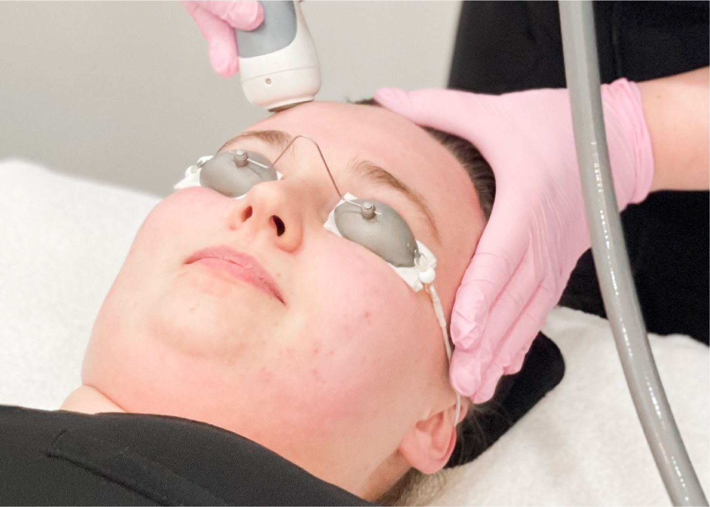 Model receiving laser treatment for hyperpigmentation and scar reduction.