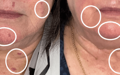 Real Stories: Laser Technicians Changing Lives Through Skin Treatments