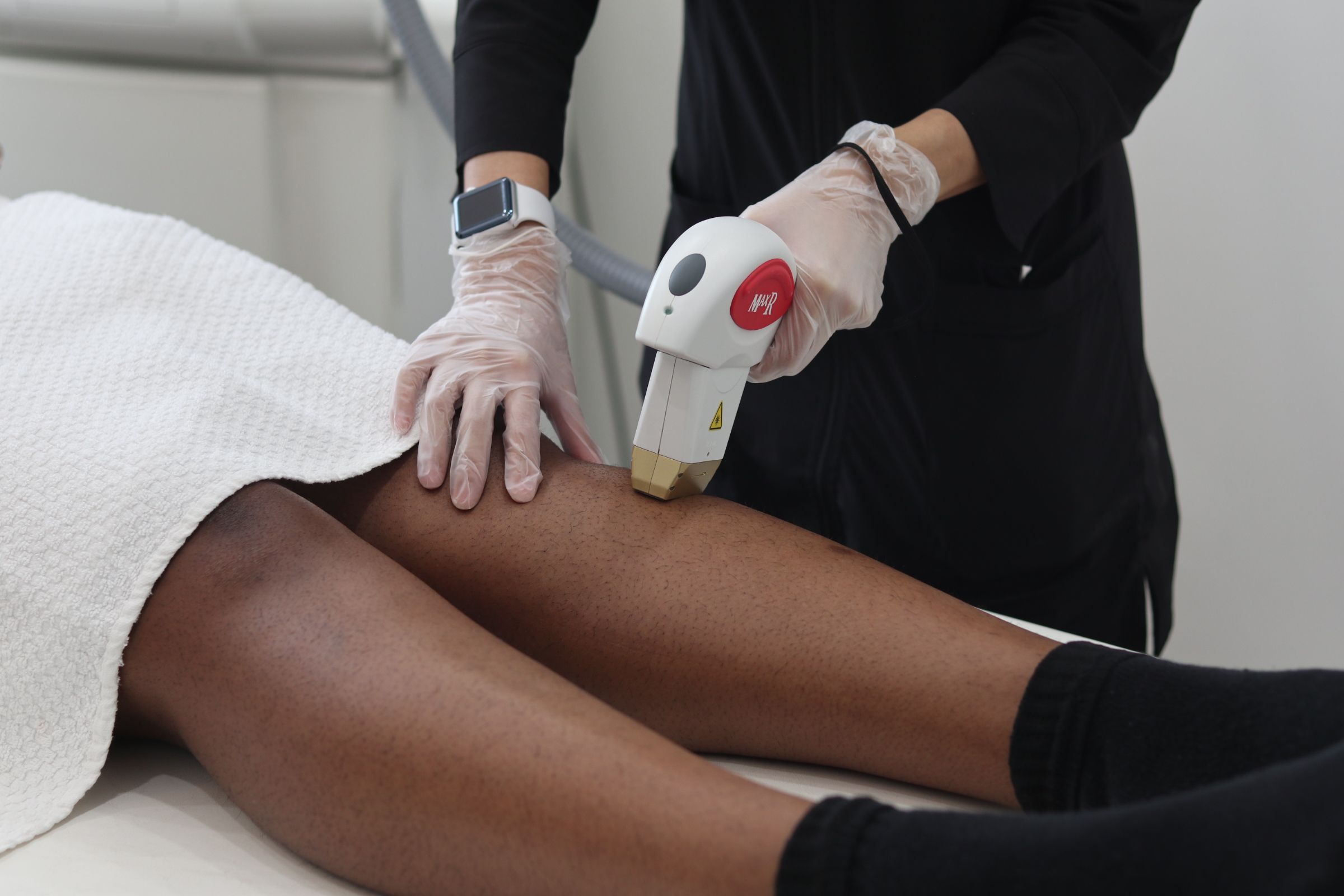 laser hair removal on legs