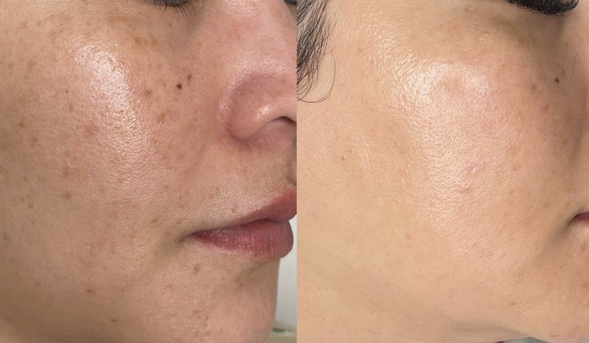 Results of laser for hyperpigmentation showing clearer skin