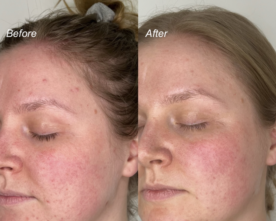 before and after a chemical peel showing improved skin clarity