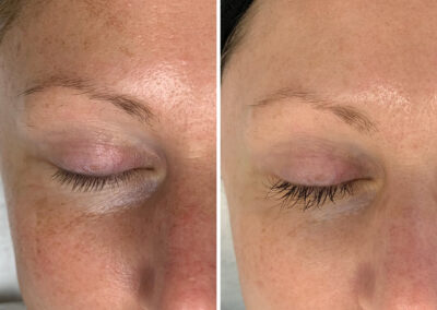 IPL Photofacial Results by Total Wrapture Medi Spa
