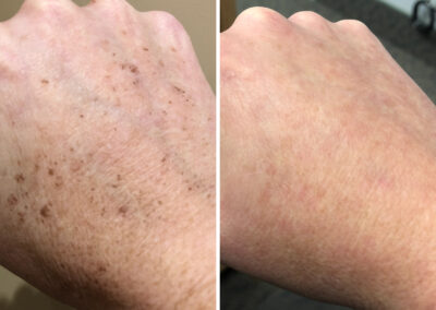 IPL Photofacial Results by Total Wrapture Medi Spa