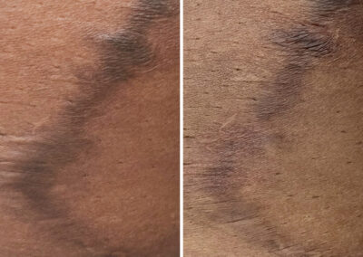 Fractional Laser Results by Total Wrapture Medi Spa