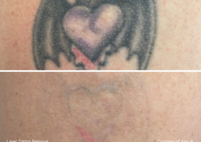 Tattoo Removal Results by Total Wrapture Medi Spa