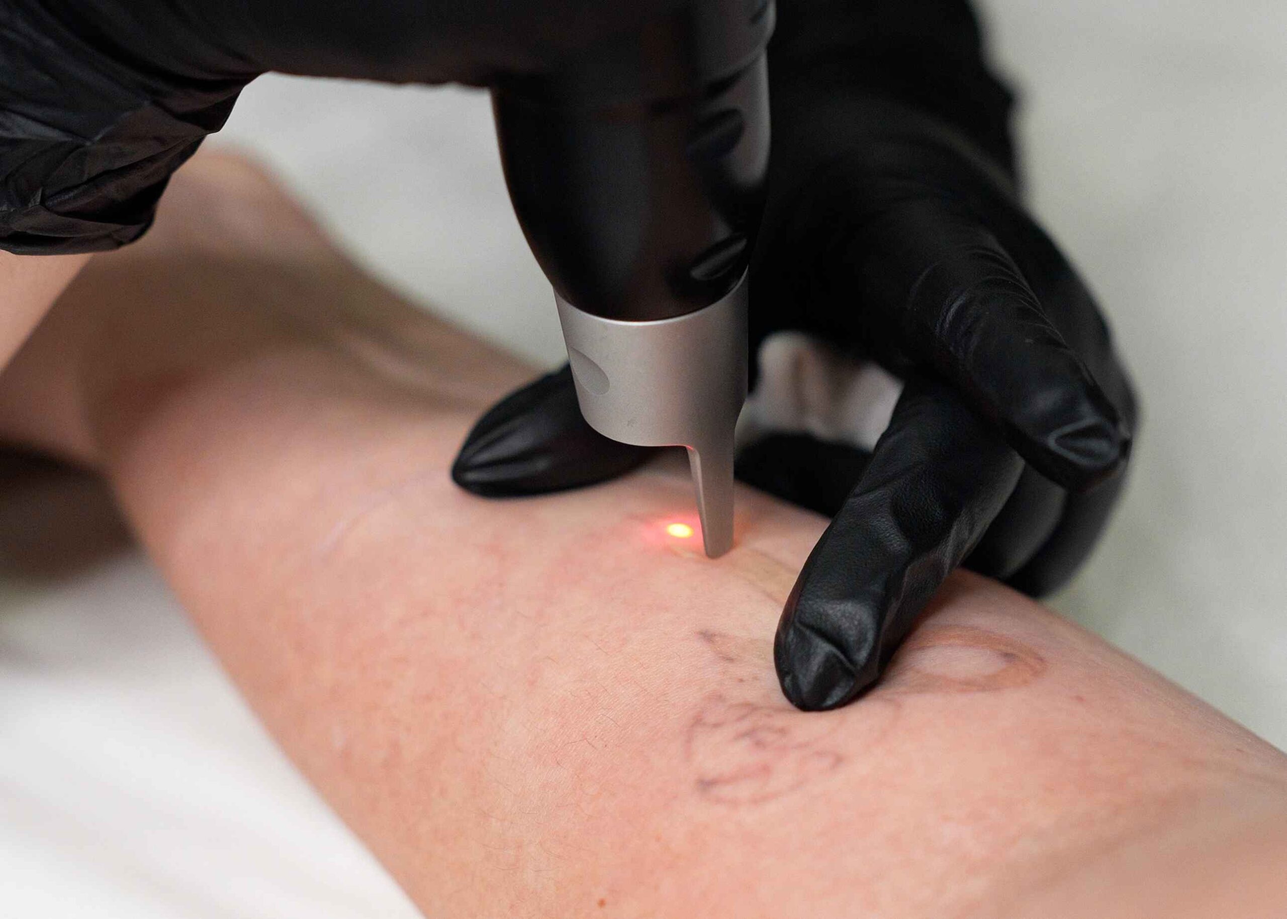 Laser tattoo removal treatment in progress at Wrapture Beauty Academy, using advanced laser technology to fade unwanted tattoos.