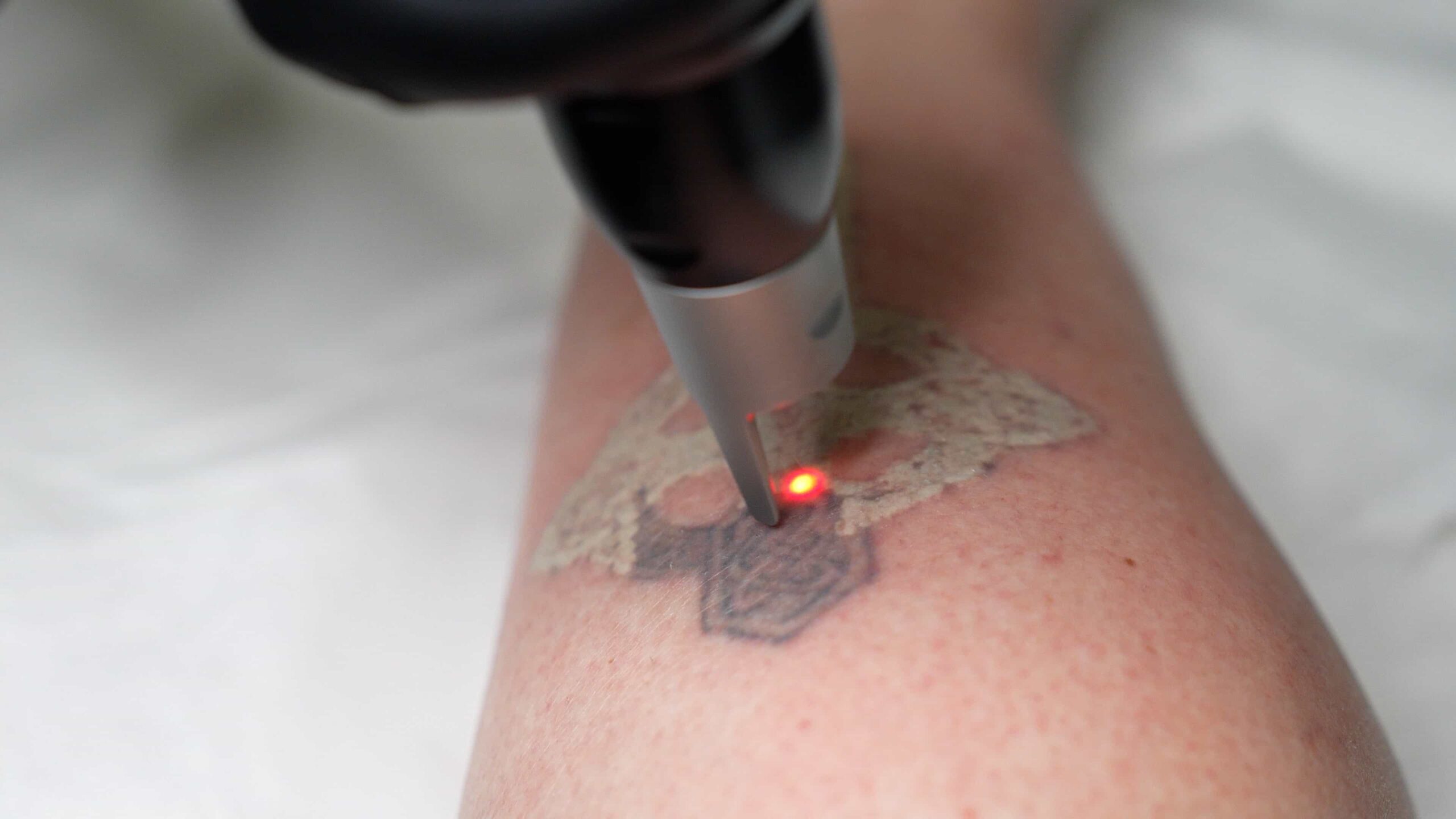 Close-up of a laser removing a tattoo on skin, illustrating training skills taught in a laser tattoo removal course Winnipeg.